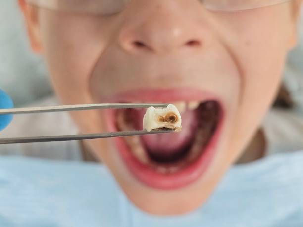 Best Emergency Gum Treatment in St Joseph, MN